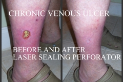 Ulcer-01