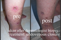 Ulcer-02