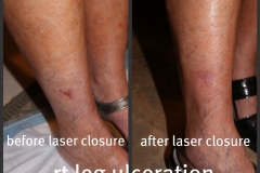 Ulcer-05
