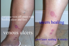 Ulcer-06