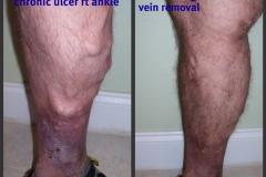 Ulcer-07