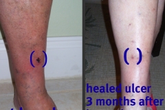 Ulcer-08