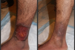 Ulcer-09