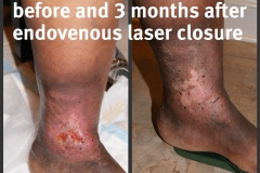 Ulcer-10