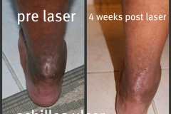 Ulcer-Achilles