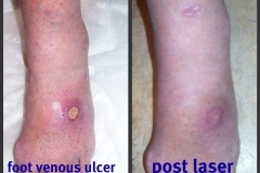 Ulcer-Dorsal-Foot