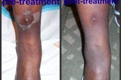 Ulcer-Pretibial
