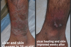 Ulcer-Shag
