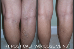 POST-CALF-VV-ELT-AND-VVE