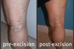 varicose-veins-rt-post-leg