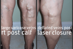 varicose-veins-rt-post-pop