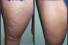 varicose-veins-thigh-prepost