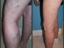 Sclerotherapy