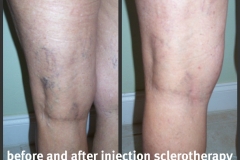 sclerotherapy-03