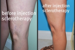 sclerotherapy-08