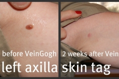 axillary-skin-tag