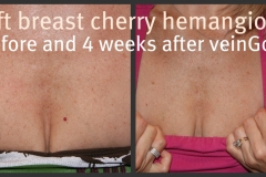 breast-hemangioma