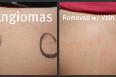 chest-wall-hemangiomas