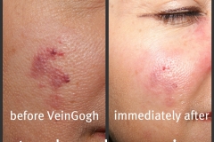 facial-hemangioma