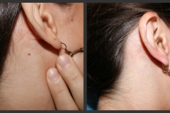 hemangioma-neck