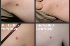 skin-tags