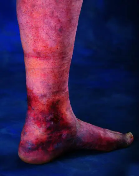 Leg Ulcer
