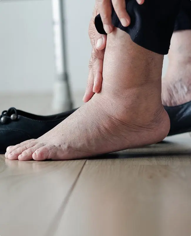 Vein Specialists help with painful and swollen legs