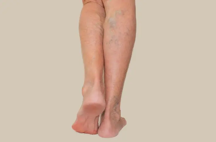 legs spider veins on legs