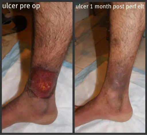 Before and after photo 1 month apart after leg vein treatment