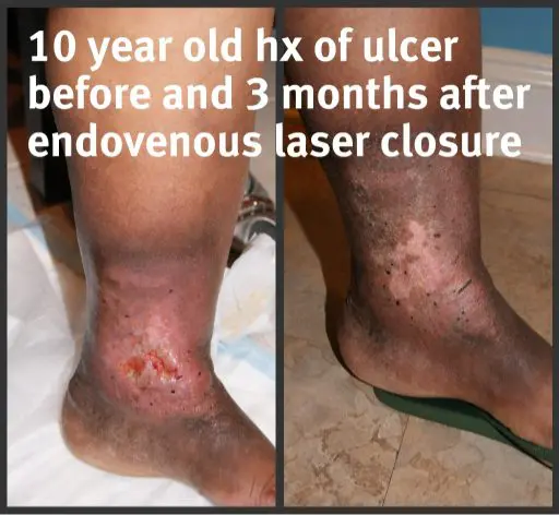10year old ulcer before and 3 months after endovenous laser closure