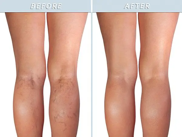Before and After Vein Treatment