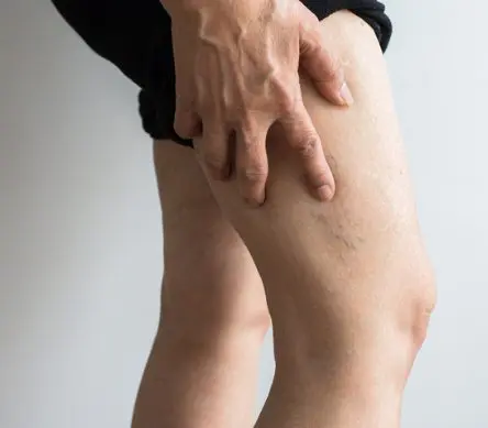 vein-symptoms-for-checklist Experiencing Vein Symptoms