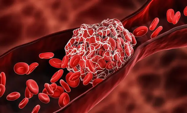 depiction-of-blood-clot-in-vein Depiction of blockage caused by iliac venous compression syndrome