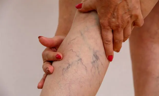 iliac-vein-syndrome-legs-with-veins-showing Varicose veins on leg