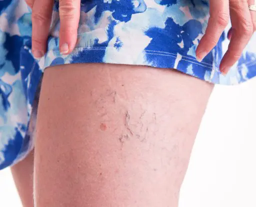 GettyImages-537851113 Endovenous Ablation