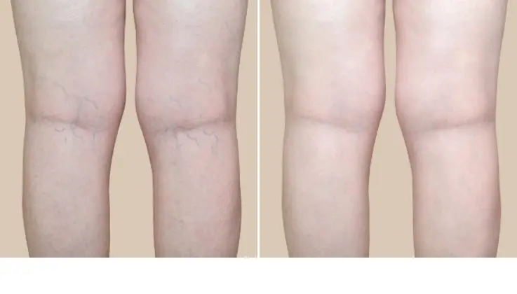 before-after Before & After Spider Vein Treatment