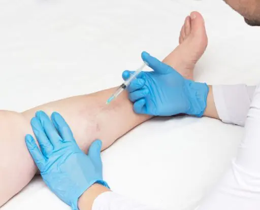 procedure The benefits of sclerotherapy to treat spider veins include minimal discomfort and a short healing process.