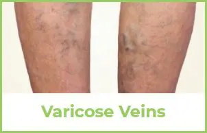 Varicose Veins Example
