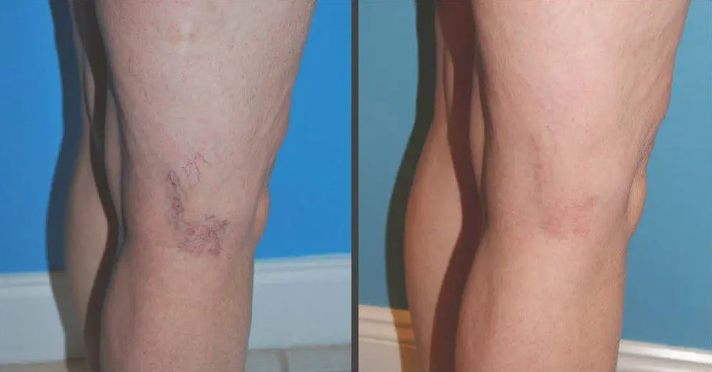 spider veins treated with injection sclerotherapy Before and After Image of Spider Vein Treatment