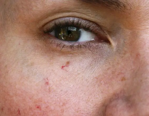 facial-close-up-veins Closeup of eye and facial veins