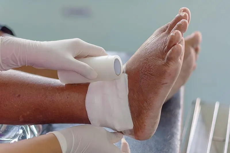 Wound,Of,Ankle,Gout,Patient wound of vein care chronic wound patient