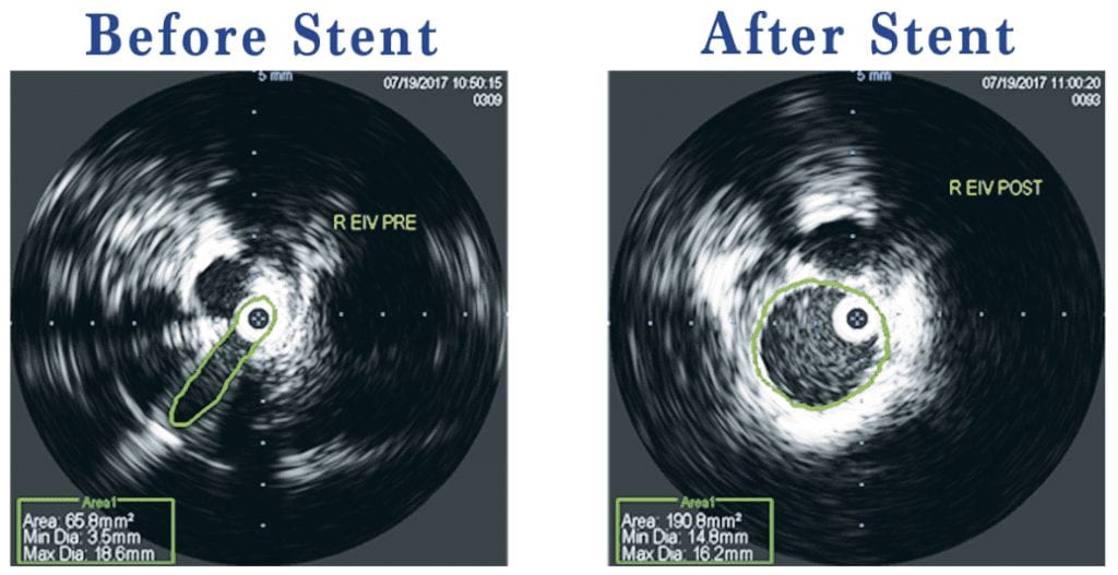 Iliac Vein Compression