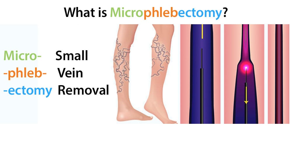Small Vein Removal
