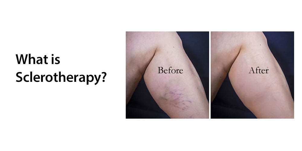 Sclerotherapy Spider Vein Removal