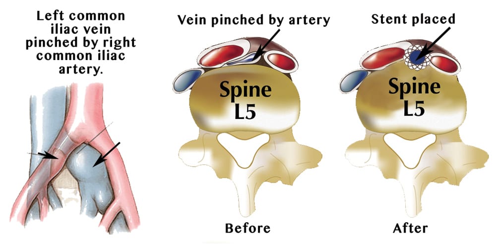 Iliac Vein Compression Syndrome