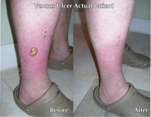 Before and after image of wound care treatements