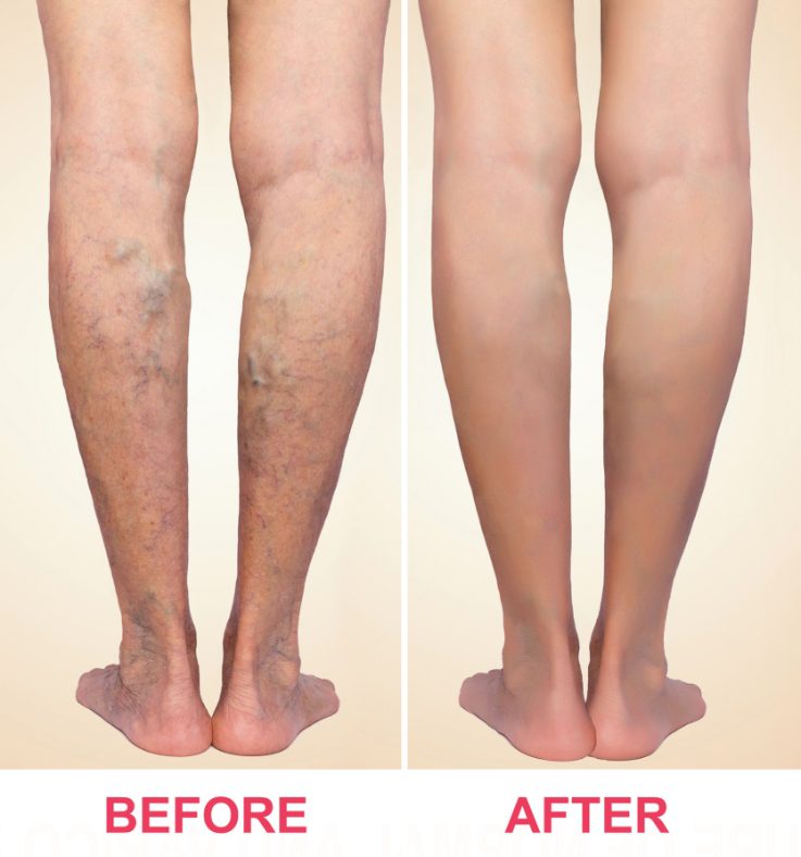 varicose veins before and after