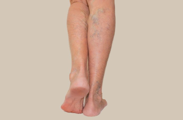 spider veins on legs