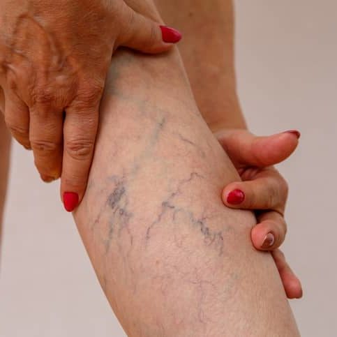 varicose veins varicose veins