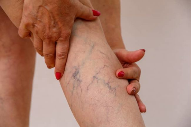 varicose veins